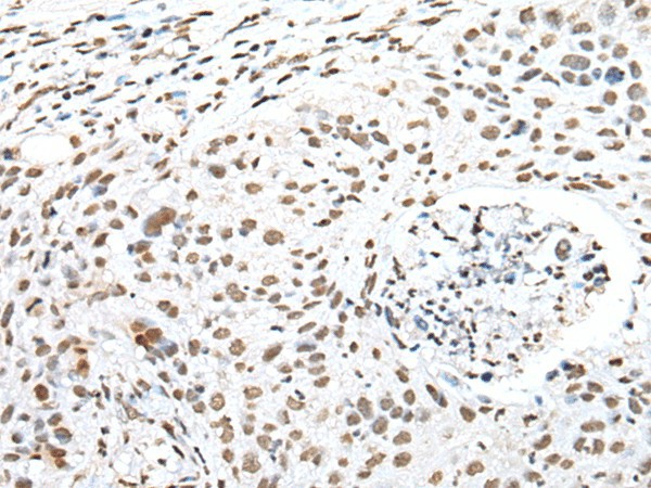 Immunohistochemistry of paraffin-embedded Human lung cancer tissue  using SNRPA Polyclonal Antibody at dilution of 1:30(?200)