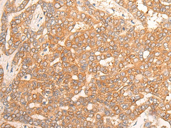 Immunohistochemistry of paraffin-embedded Human liver cancer tissue  using CPS1 Polyclonal Antibody at dilution of 1:35(?200)