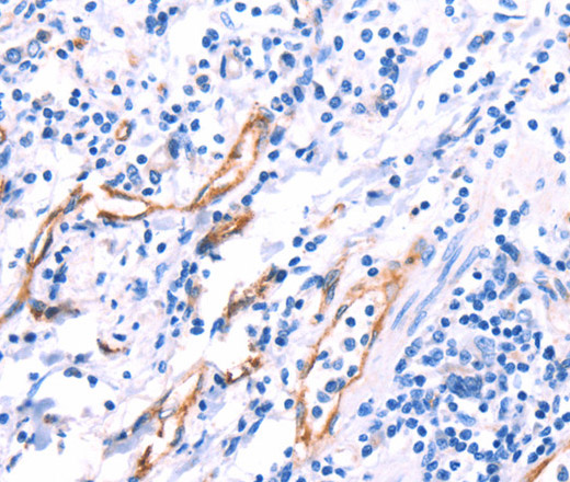 Immunohistochemistry of paraffin-embedded Human gasrtic cancer tissue using VWF Polyclonal Antibody at dilution 1:50