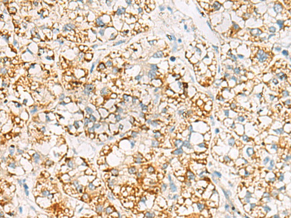 Immunohistochemistry of paraffin-embedded Human liver cancer tissue  using MRPL20 Polyclonal Antibody at dilution of 1:60(?200)