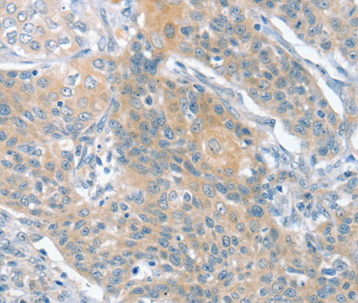 Immunohistochemistry of paraffin-embedded Human cervical cancer using SLIT2 Polyclonal Antibody at dilution of 1:30