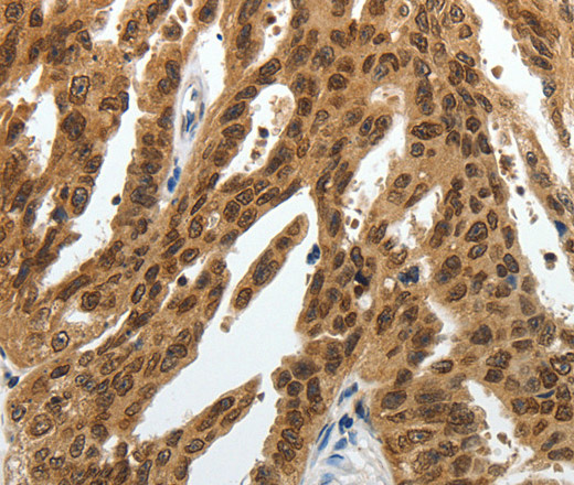 Immunohistochemistry of paraffin-embedded Human ovarian cancer tissue using SUMO1 Polyclonal Antibody at dilution 1:30