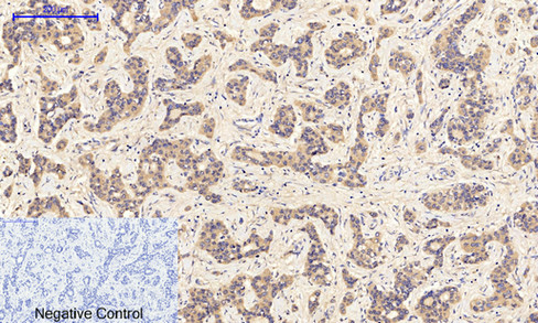 Immunohistochemistry of paraffin-embedded Human liver cancer tissue with Phospho-JAK1 (Tyr1022) Polyclonal Antibody at dilution of 1:200