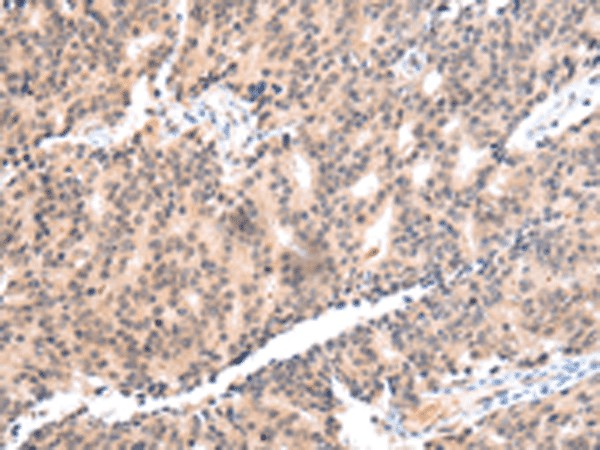 Immunohistochemistry of paraffin-embedded Human prost at e cancer tissue  using COX17 Polyclonal Antibody at dilution of 1:55(?200)