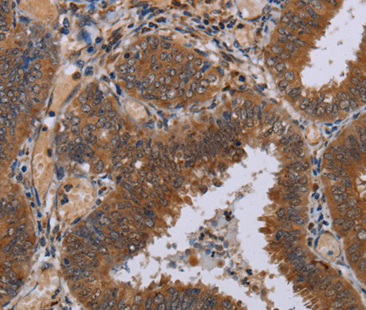 Immunohistochemistry of paraffin-embedded Human colon cancer tissue using NPTX1 Polyclonal Antibody at dilution 1:50