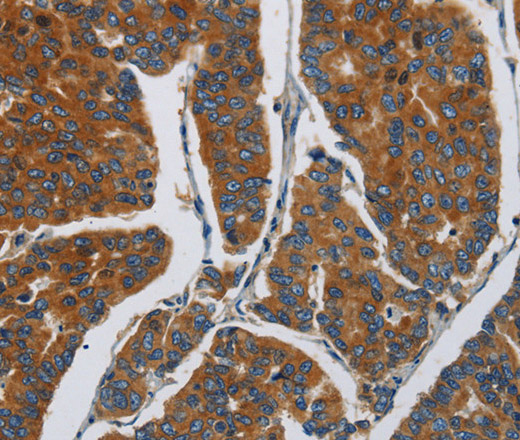 Immunohistochemistry of paraffin-embedded Human breast cancer using APEH  Polyclonal Antibody at dilution of 1:30