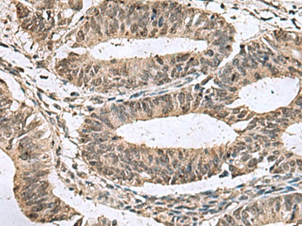 Immunohistochemistry of paraffin-embedded Human colorectal cancer tissue  using TMX3 Polyclonal Antibody at dilution of 1:70(?200)