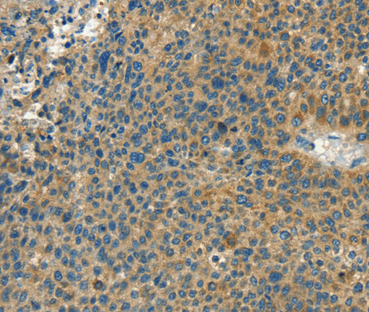 Immunohistochemistry of paraffin-embedded Human liver cancer tissue using CALCA Polyclonal Antibody at dilution 1:60