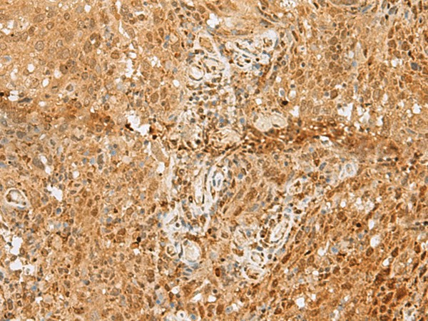 Immunohistochemistry of paraffin-embedded Human cervical cancer tissue  using PNRC2 Polyclonal Antibody at dilution of 1:50(?200)