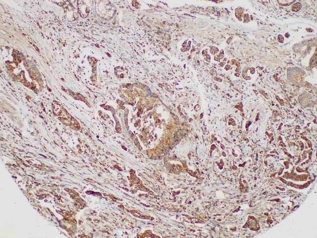 Immunohistochemistry of paraffin-embedded Human duodenal carcinoma using S100A4 Polycloanl Antibody at dilution of 1:200