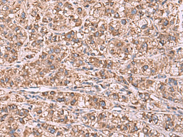 Immunohistochemistry of paraffin-embedded Human liver cancer tissue  using GUSB Polyclonal Antibody at dilution of 1:75(?200)