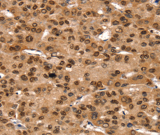 Immunohistochemistry of paraffin-embedded Human liver cancer using TAF10 Polyclonal Antibody at dilution of 1:35