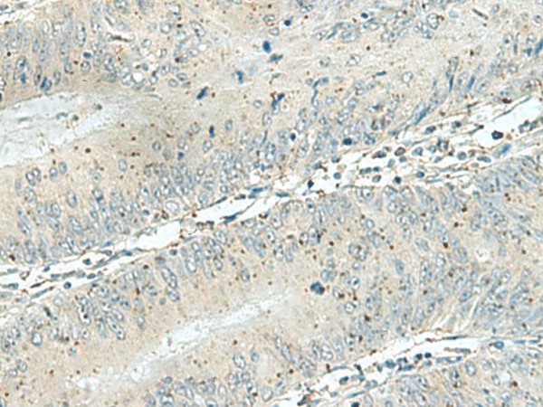 Immunohistochemistry of paraffin-embedded Human colorectal cancer tissue  using DENND6A Polyclonal Antibody at dilution of 1:120(?200)