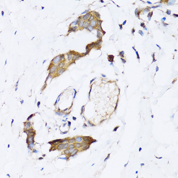 Immunohistochemistry of paraffin-embedded Human breast cancer using NAA10 Polyclonal Antibody at dilution of 1:100 (40x lens).