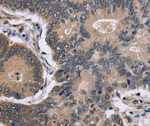 Immunohistochemistry of paraffin-embedded Human colon cancer tissue using FSTL1 Polyclonal Antibody at dilution 1:40