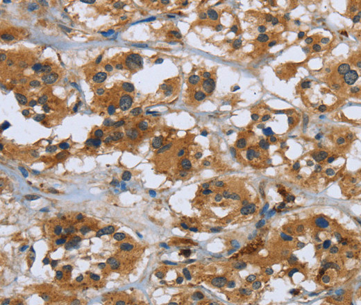 Immunohistochemistry of paraffin-embedded Human thyroid cancer using RAP1B Polyclonal Antibody at dilution of 1:50