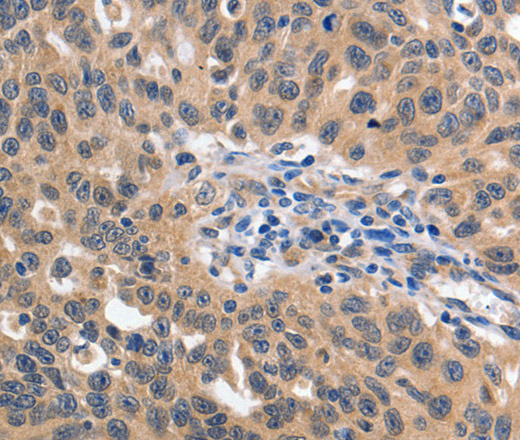 Immunohistochemistry of paraffin-embedded Human ovarian cancer using 14-3-3 epsilon Polyclonal Antibody at dilution of 1:60