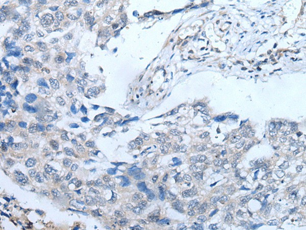 Immunohistochemistry of paraffin-embedded Human lung cancer tissue  using UBR4 Polyclonal Antibody at dilution of 1:65(?200)