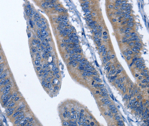 Immunohistochemistry of paraffin-embedded Human colon cancer using HSF27 Polyclonal Antibody at dilution of 1:60