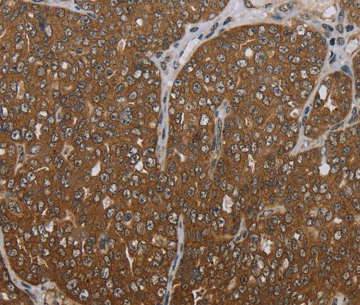 Immunohistochemistry of paraffin-embedded Human ovarian cancer tissue using FOLH1B Polyclonal Antibody at dilution 1:30