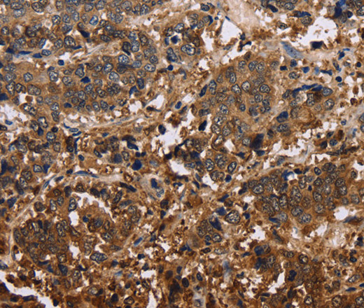 Immunohistochemistry of paraffin-embedded Human liver cancer tissue using FBP2 Polyclonal Antibody at dilution 1:40