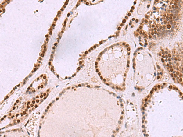 Immunohistochemistry of paraffin-embedded Human thyroid cancer tissue  using CUL4A Polyclonal Antibody at dilution of 1:55(?200)