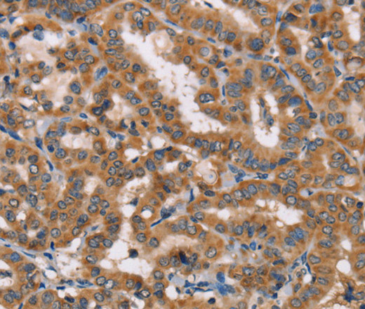 Immunohistochemistry of paraffin-embedded Human thyroid cancer using HTR3C Polyclonal Antibody at dilution of 1:40