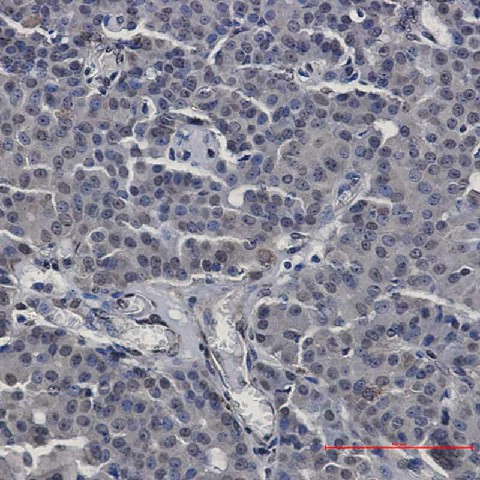 Immunohistochemistry of STAT5b in paraffin-embedded Human breast cancer tissue using STAT5b Rabbit mAb at dilution 1:50