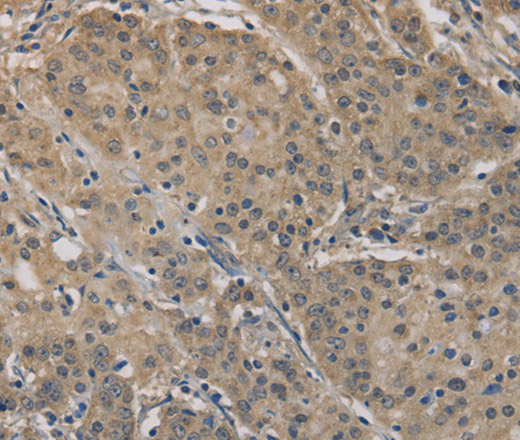 Immunohistochemistry of paraffin-embedded Human gastric cancer tissue using AGTRAP Polyclonal Antibody at dilution 1:40