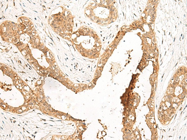 Immunohistochemistry of paraffin-embedded Human breast cancer tissue  using LDHA Polyclonal Antibody at dilution of 1:40(?200)