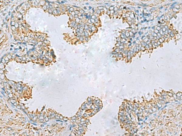 Immunohistochemistry of paraffin-embedded Human prost ate cancer tissue  using PLA2G15 Polyclonal Antibody at dilution of 1:65(?200)