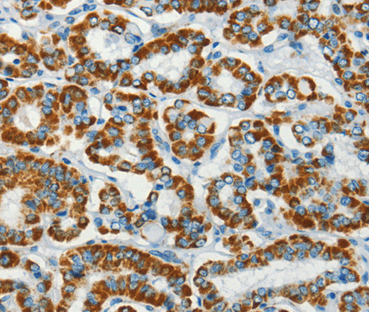 Immunohistochemistry of paraffin-embedded Human thyroid cancer using BCAT2 Polyclonal Antibody at dilution of 1:70