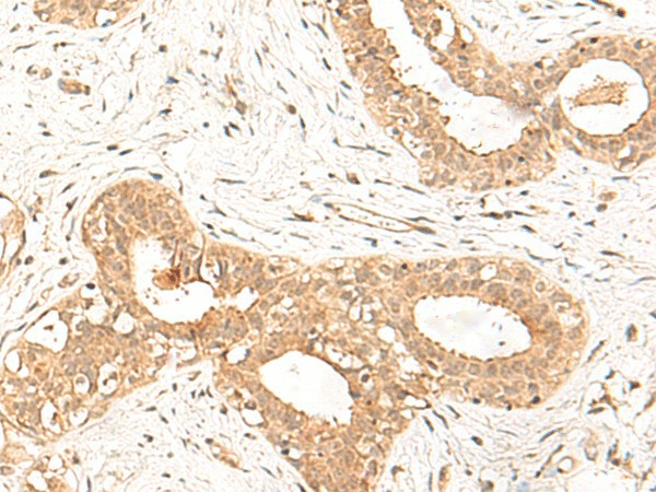 Immunohistochemistry of paraffin-embedded Human breast cancer tissue  using FBXL4 Polyclonal Antibody at dilution of 1:25(?200)