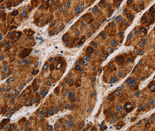 Immunohistochemistry of paraffin-embedded Human liver cancer using IL17RA Polyclonal Antibody at dilution of 1:40