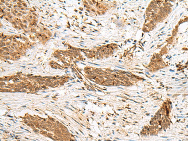 Immunohistochemistry of paraffin-embedded Human esophagus cancer tissue  using NUP58 Polyclonal Antibody at dilution of 1:50(?200)