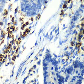 Immunohistochemistry of paraffin-embedded Human colon carcinoma using ASGR1 Polyclonal Antibody at dilution of 1:100 (40x lens).