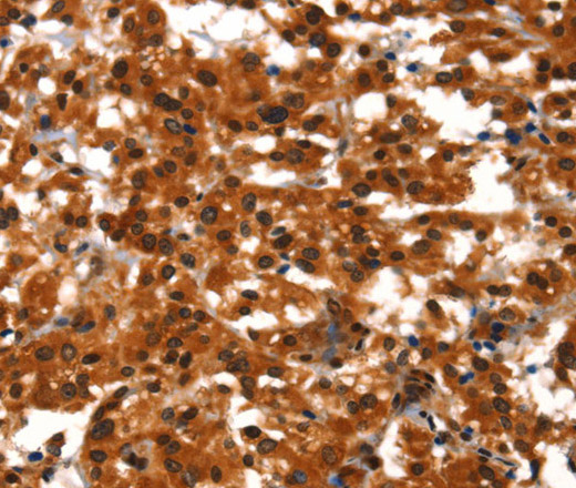 Immunohistochemistry of paraffin-embedded Human thyroid cancer tissue using BCAS3 Polyclonal Antibody at dilution 1:40