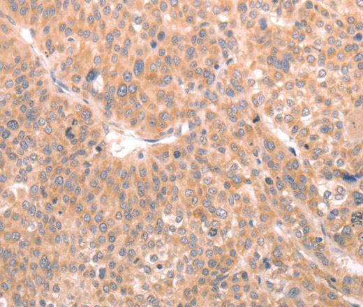 Immunohistochemistry of paraffin-embedded Human liver cancer tissue using ABCF1 Polyclonal Antibody at dilution 1:40