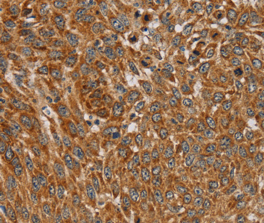 Immunohistochemistry of paraffin-embedded Human lung cancer using PLEKHG6 Polyclonal Antibody at dilution of 1:45