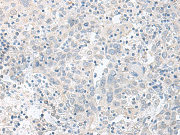 Immunohistochemistry of paraffin-embedded Human cervical cancer tissue  using TIMM8A Polyclonal Antibody at dilution of 1:90(?200)