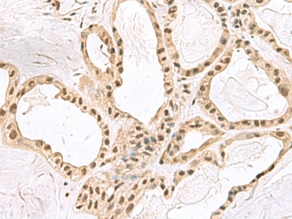 Immunohistochemistry of paraffin-embedded Human thyroid cancer tissue  using PCLAF Polyclonal Antibody at dilution of 1:60(?200)