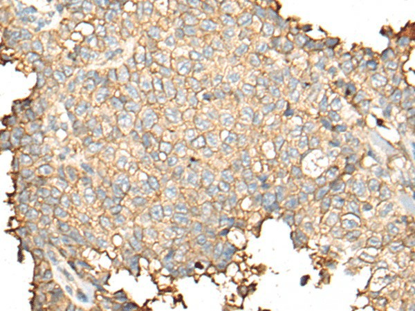 Immunohistochemistry of paraffin-embedded Human ovarian cancer tissue  using CD55 Polyclonal Antibody at dilution of 1:35(?200)