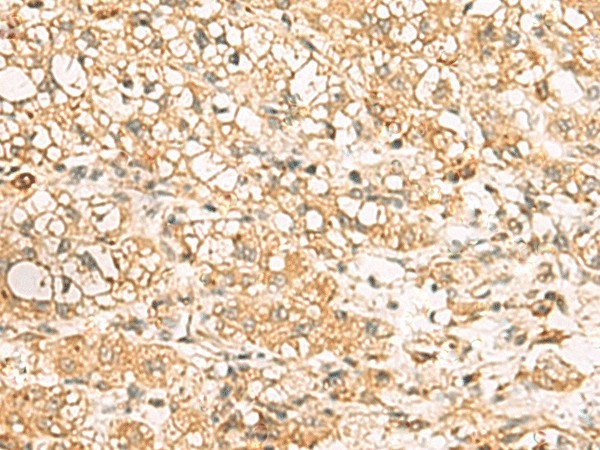 Immunohistochemistry of paraffin-embedded Human liver cancer tissue  using USP24 Polyclonal Antibody at dilution of 1:35(?200)