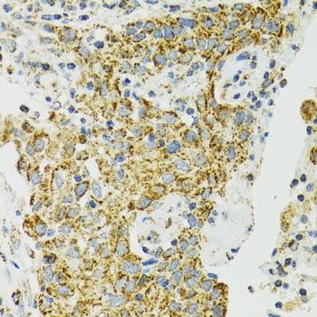 Immunohistochemistry of paraffin-embedded Human lung cancer using HSPA9 Polyclonal Antibody at dilution of 1:100 (40x lens).