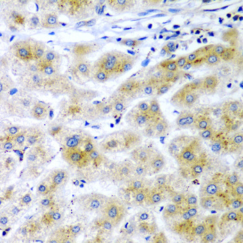 Immunohistochemistry of paraffin-embedded Human liver cancer using RARRES2 Polyclonal Antibody at dilution of 1:200 (40x lens).