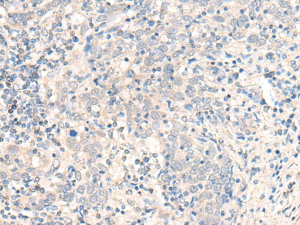 Immunohistochemistry of paraffin-embedded Human cervical cancer tissue  using CCDC47 Polyclonal Antibody at dilution of 1:25(?200)