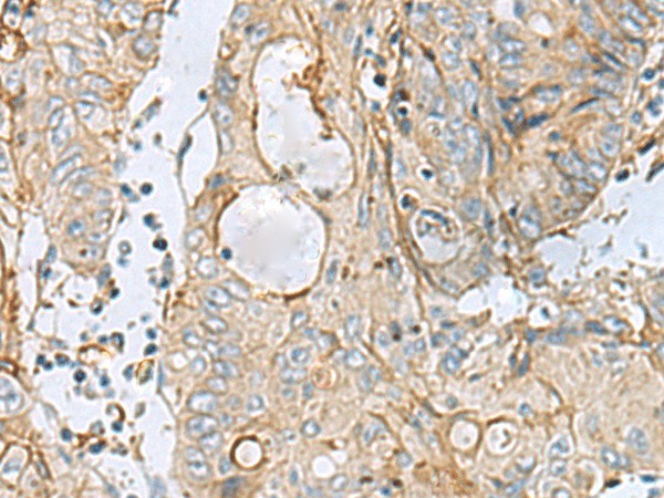 Immunohistochemistry of paraffin-embedded Human colorectal cancer tissue  using MTHFD2 Polyclonal Antibody at dilution of 1:65(?200)