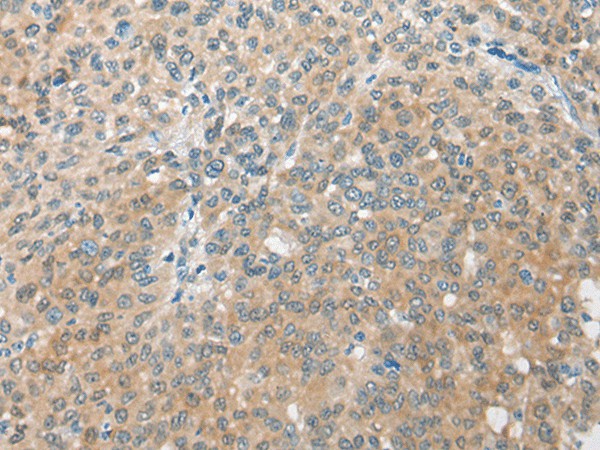 Immunohistochemistry of paraffin-embedded Human liver cancer tissue  using CBR3 Polyclonal Antibody at dilution of 1:35(?200)