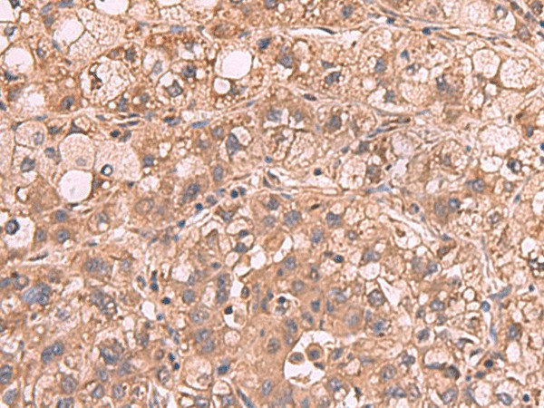 Immunohistochemistry of paraffin-embedded Human liver cancer tissue  using PPP2R1A Polyclonal Antibody at dilution of 1:65(?200)