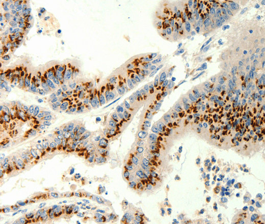 Immunohistochemistry of paraffin-embedded Human colon cancer tissue using TRPC6 Polyclonal Antibody at dilution 1:40